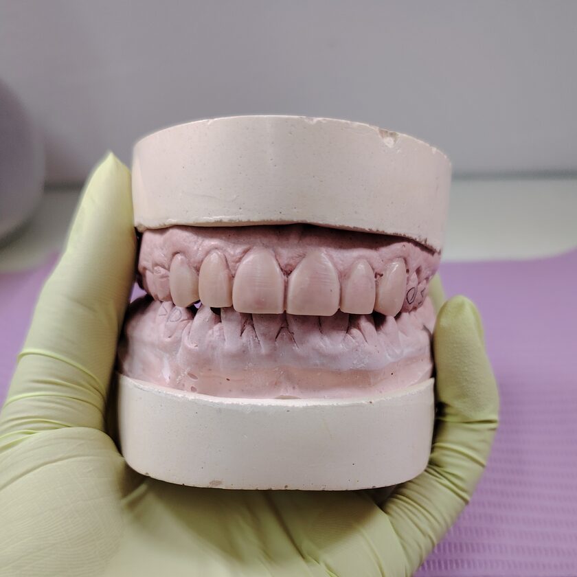 Modelo de estudio dental sostenido con guantes en el consultorio de KineDenta